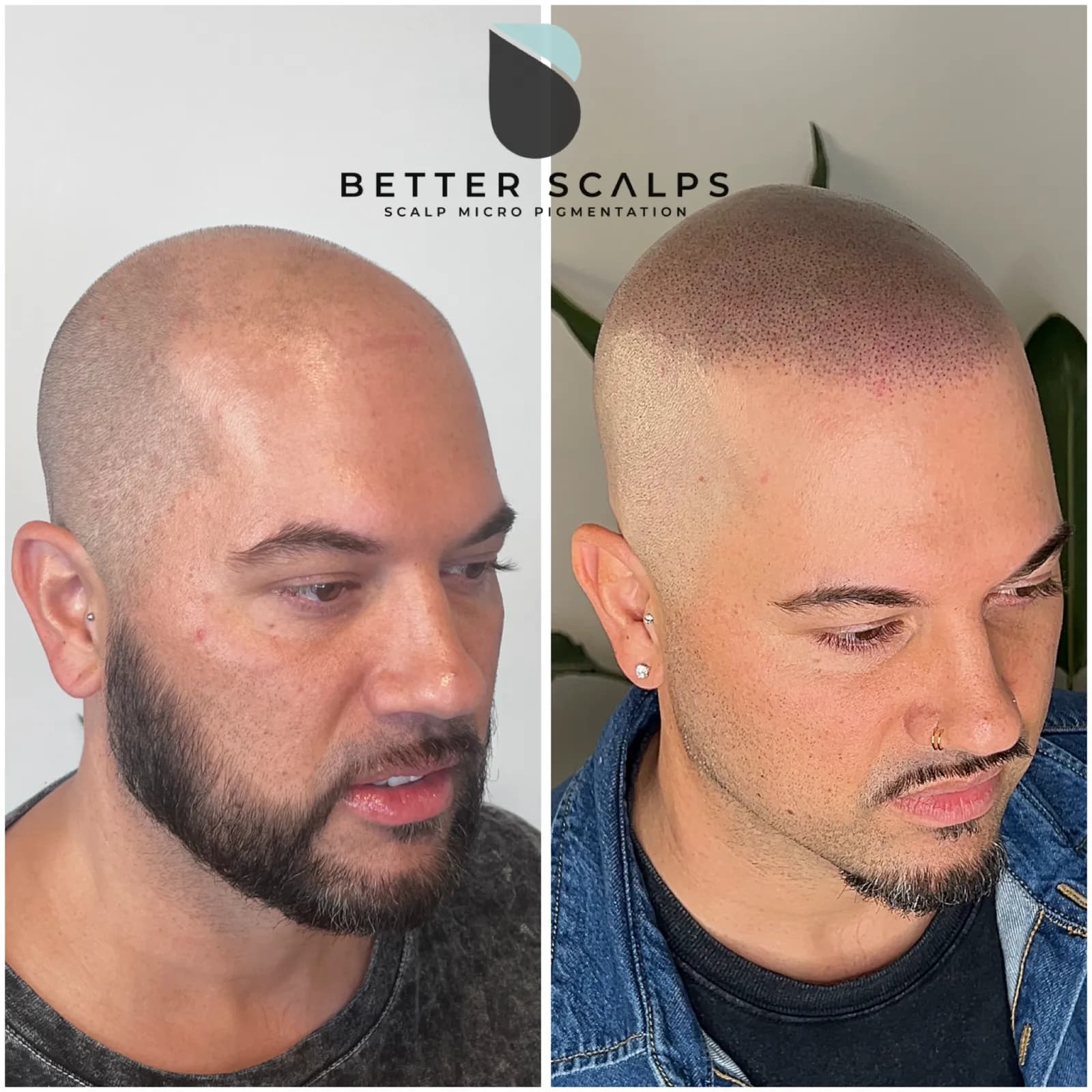 Better Scalps SMP | Scalp Micropigmentation — scalp micropigmentation studio in Dieppe