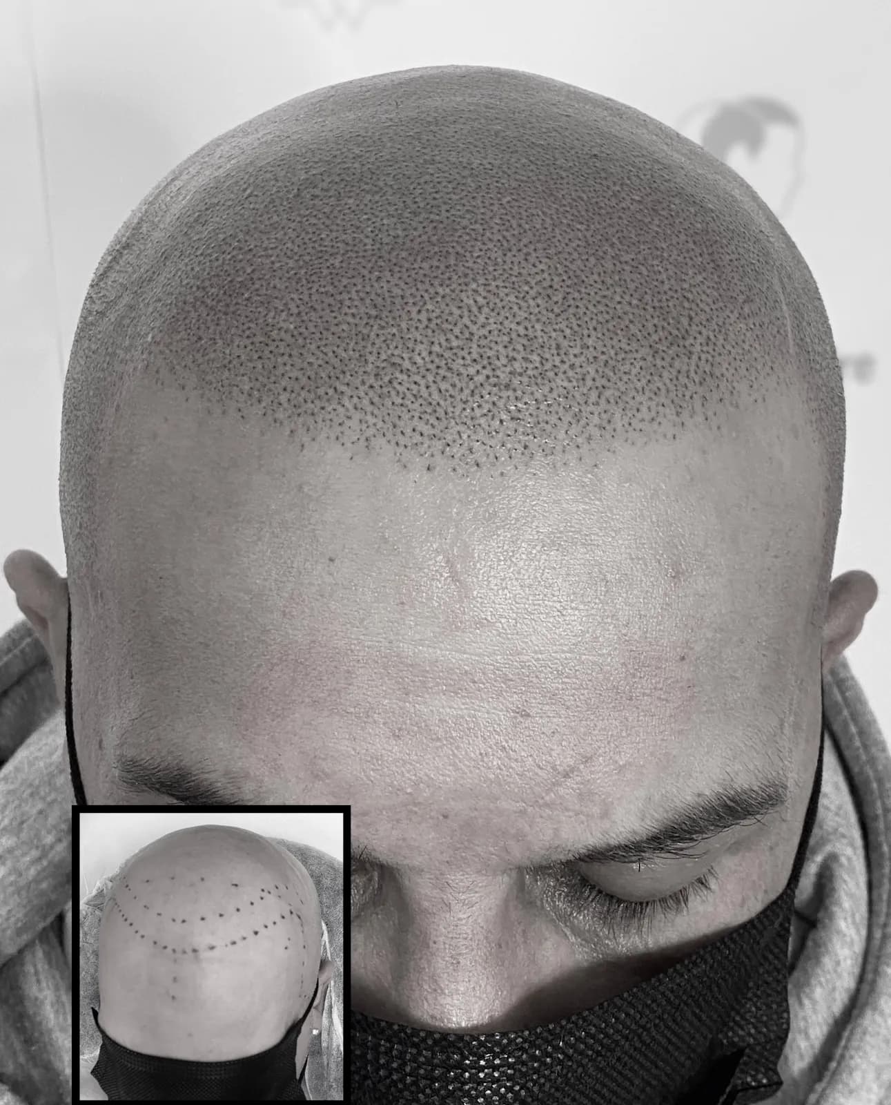 Clinique MicroCapillaire Laval - Scalp Micropigmentation Capillaire — scalp micropigmentation studio in Laval