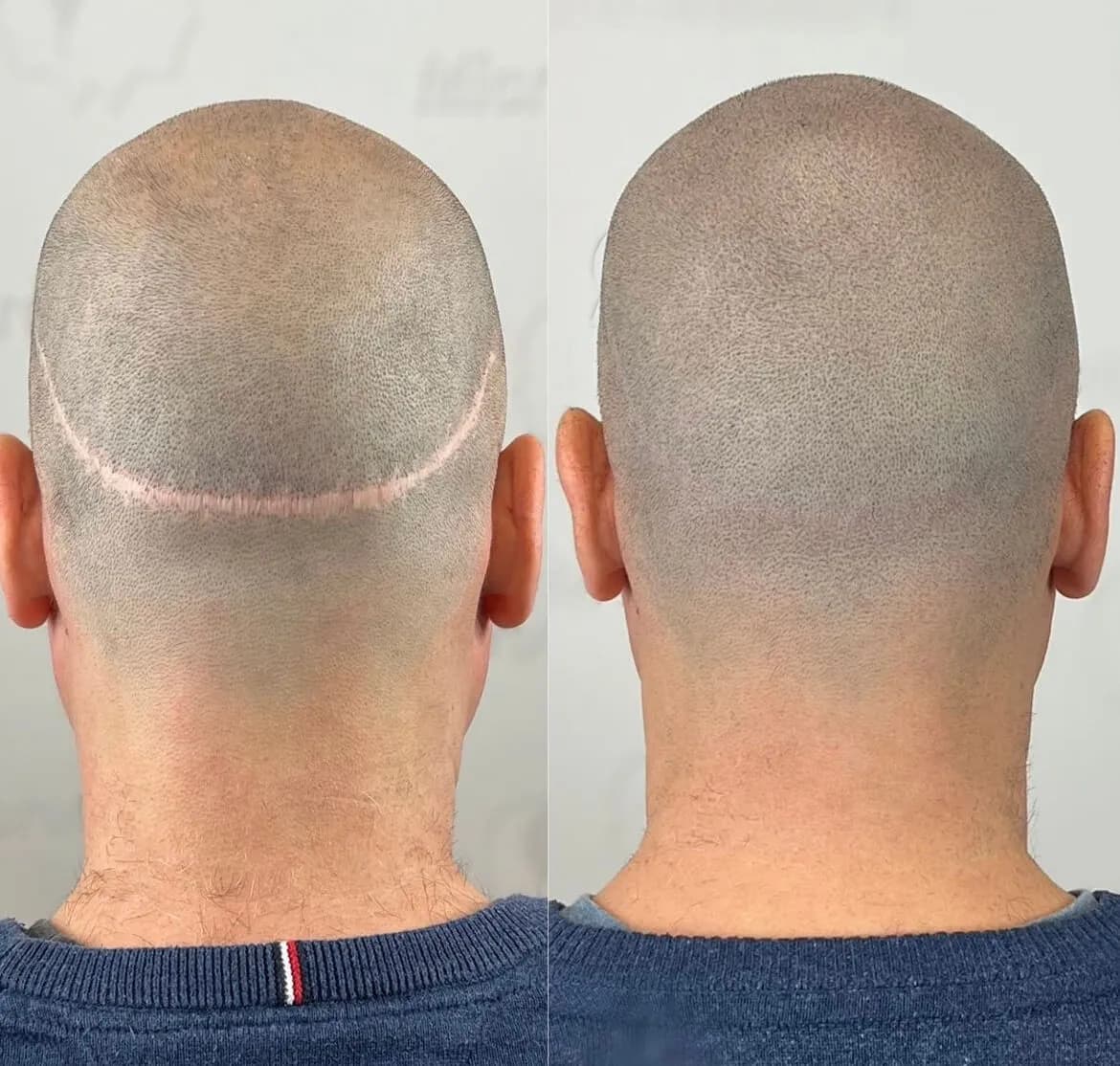 Clinique MicroCapillaire Montreal - Scalp Micropigmentation Capillaire — scalp micropigmentation studio in Montreal