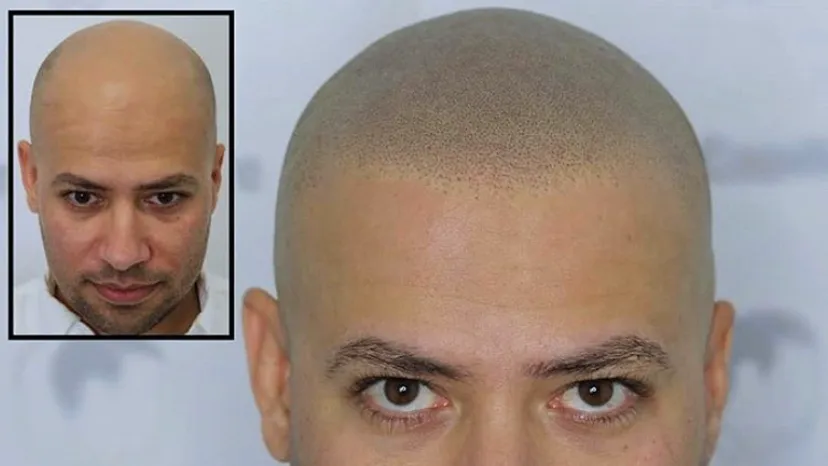 Clinique MicroCapillaire - Scalp Micropigmentation Capillaire — scalp micropigmentation studio in Ottawa