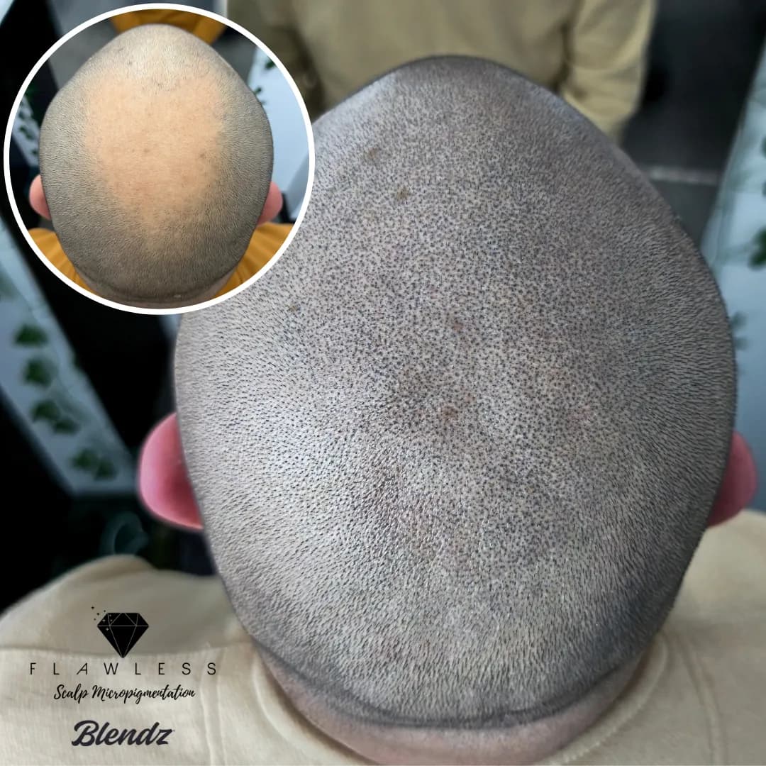Flawless SMP - Vancouver Scalp Micropigmentation — scalp micropigmentation studio in Vancouver