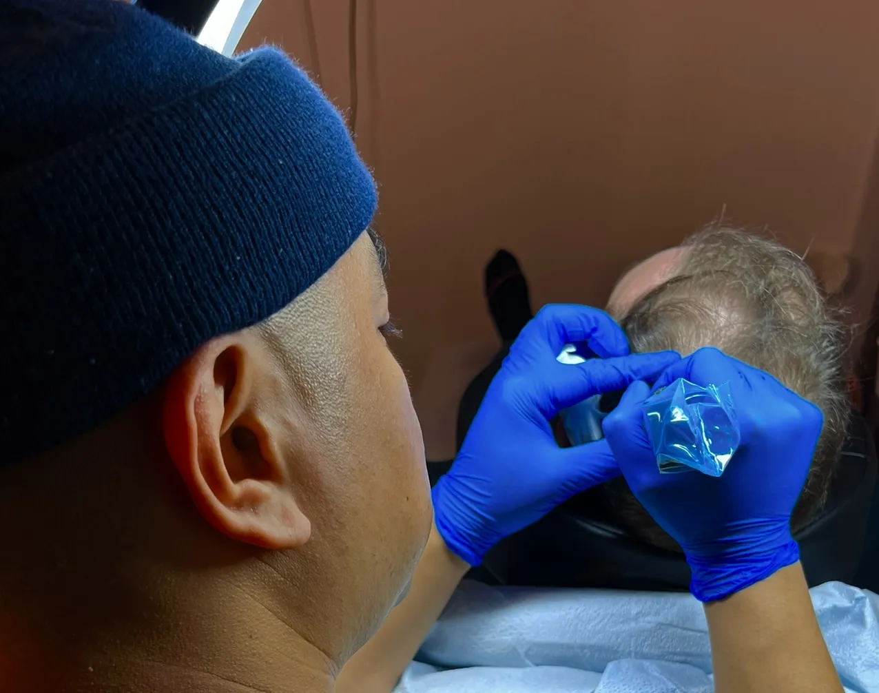 Francis SMP Vancouver Scalp Micropigmentation Specialist — scalp micropigmentation studio in Vancouver