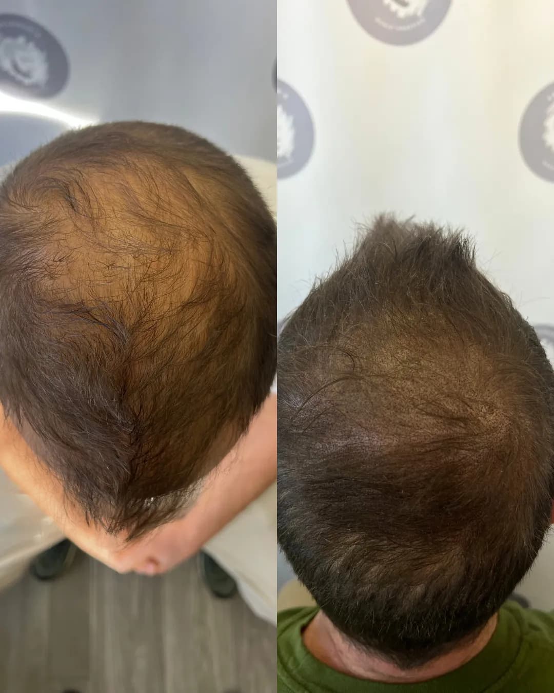 Gentlemen's Scalp Prestige — scalp micropigmentation studio in Calgary