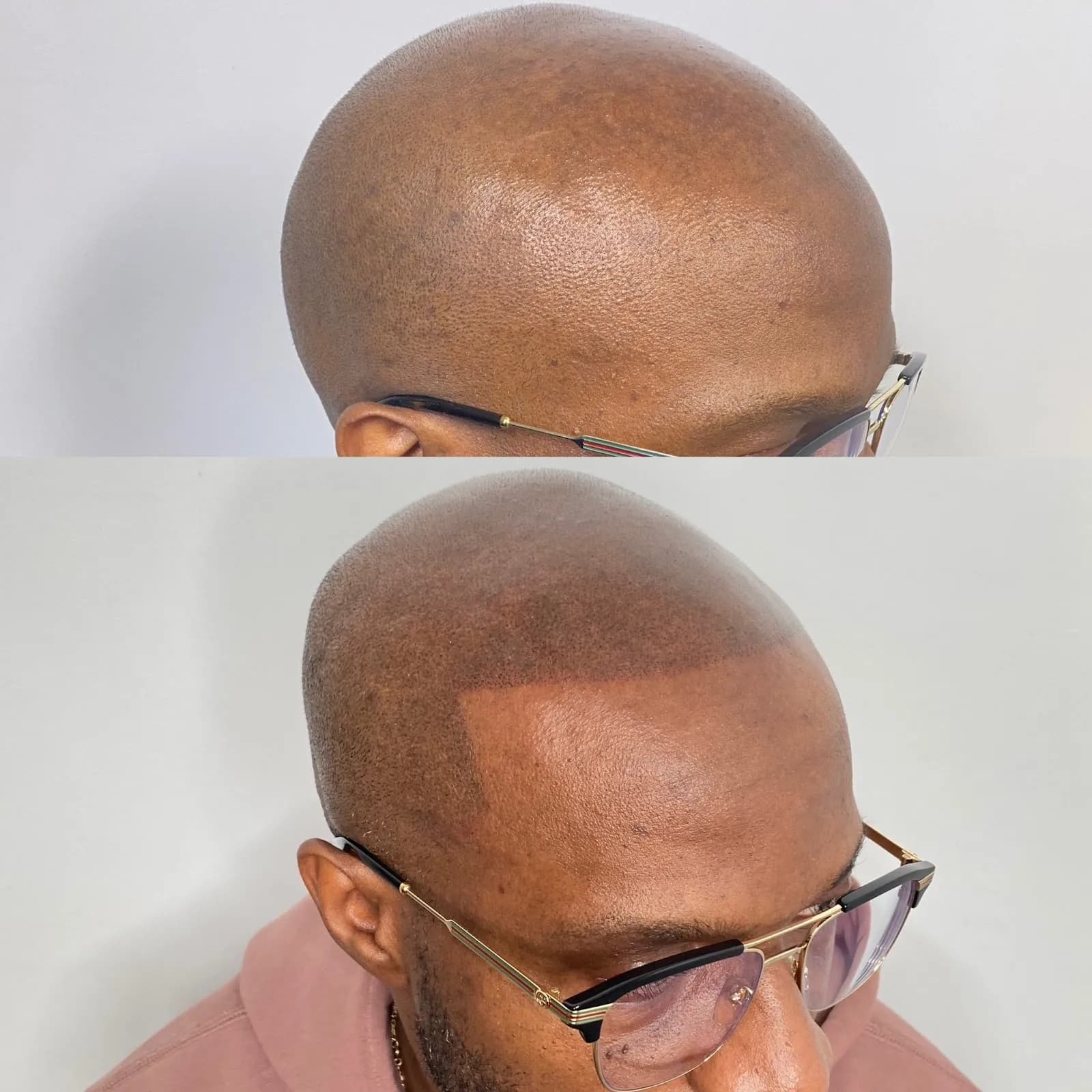 Glam Beauty Ink Studio | Scalp Micropigmentation| SMP | Permanent Make Up — scalp micropigmentation studio in Toronto