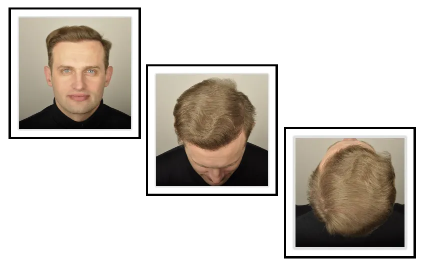 Hair Forever — scalp micropigmentation studio in Brampton