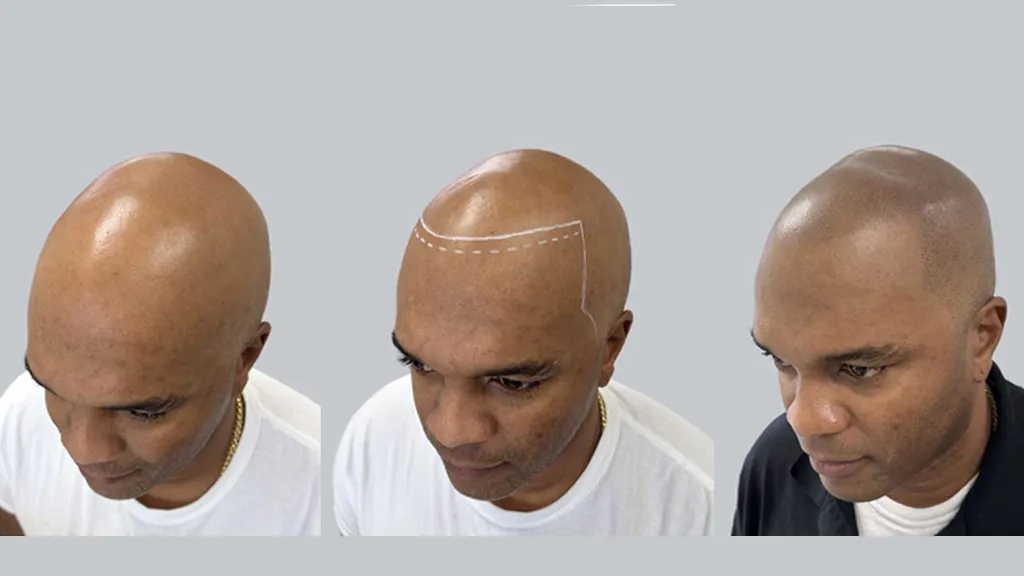 HAIR TATTOO Niagara Falls — scalp micropigmentation studio in Niagara Falls