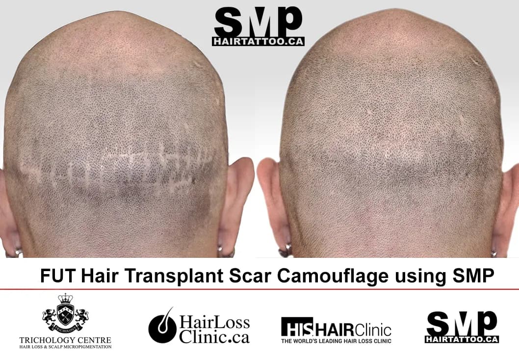 HAIRTATTOO.CA | SMP Scalp Micropigmentation — scalp micropigmentation studio in St. Catharines