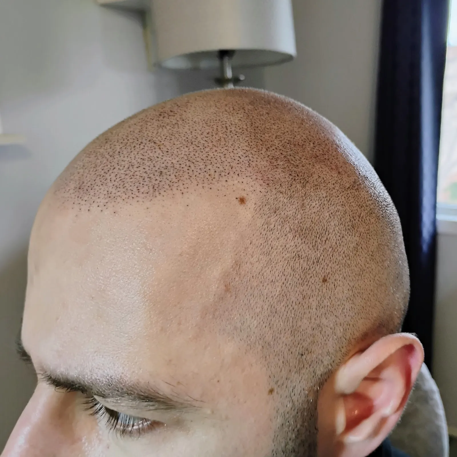 Inked Illusions - Scalp Micropigmentation (SMP Hair Tattoo) — scalp micropigmentation studio in Calgary