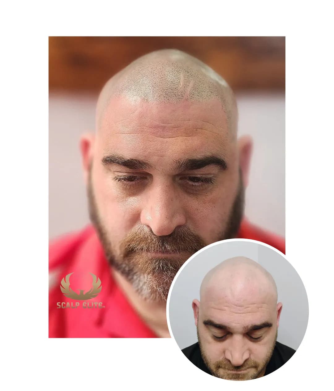 Micropigmentation Capillaire Scalp Élite — scalp micropigmentation studio in Laval