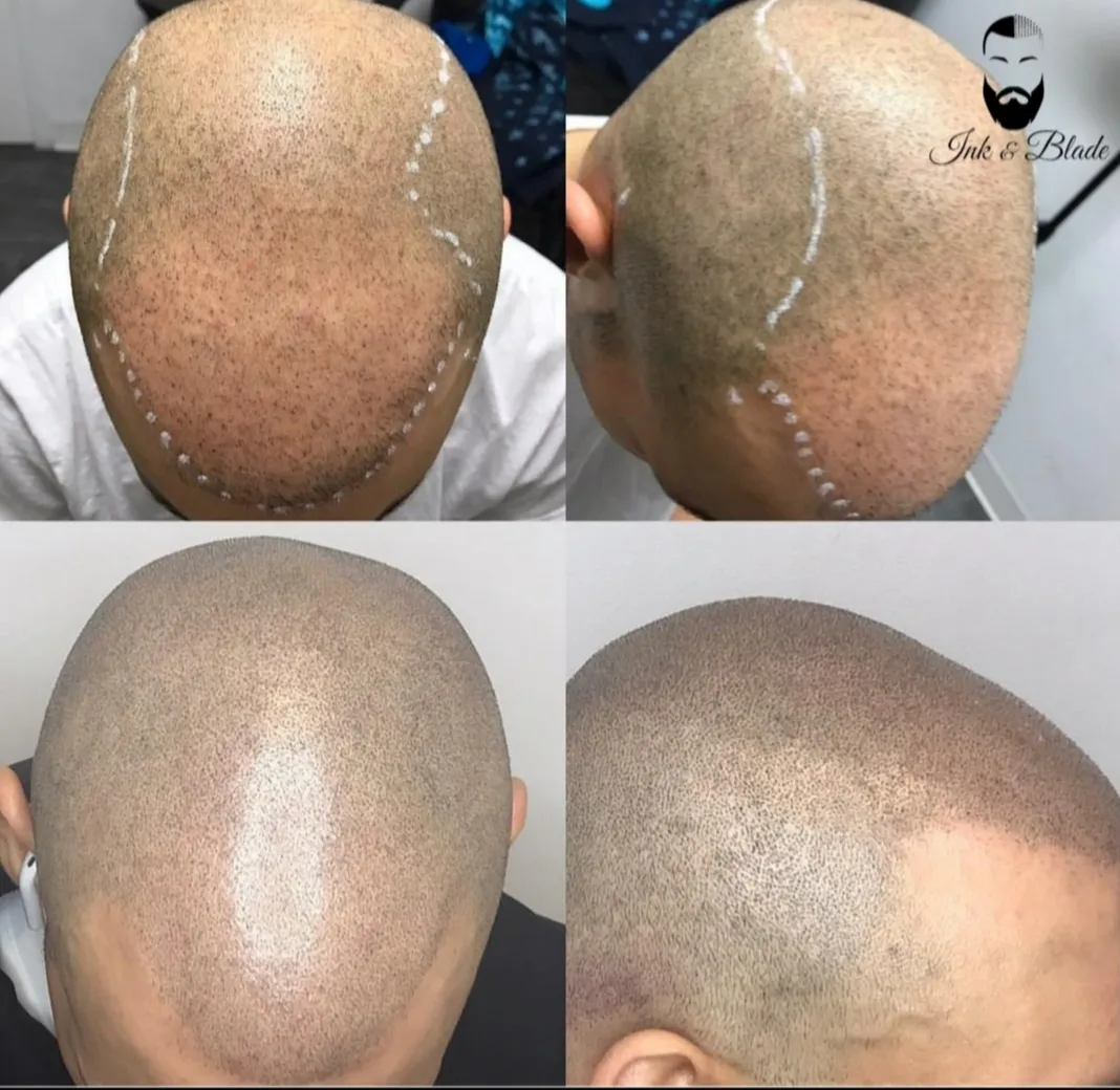 Micropigmentation Ink and Blade — scalp micropigmentation studio in Laval