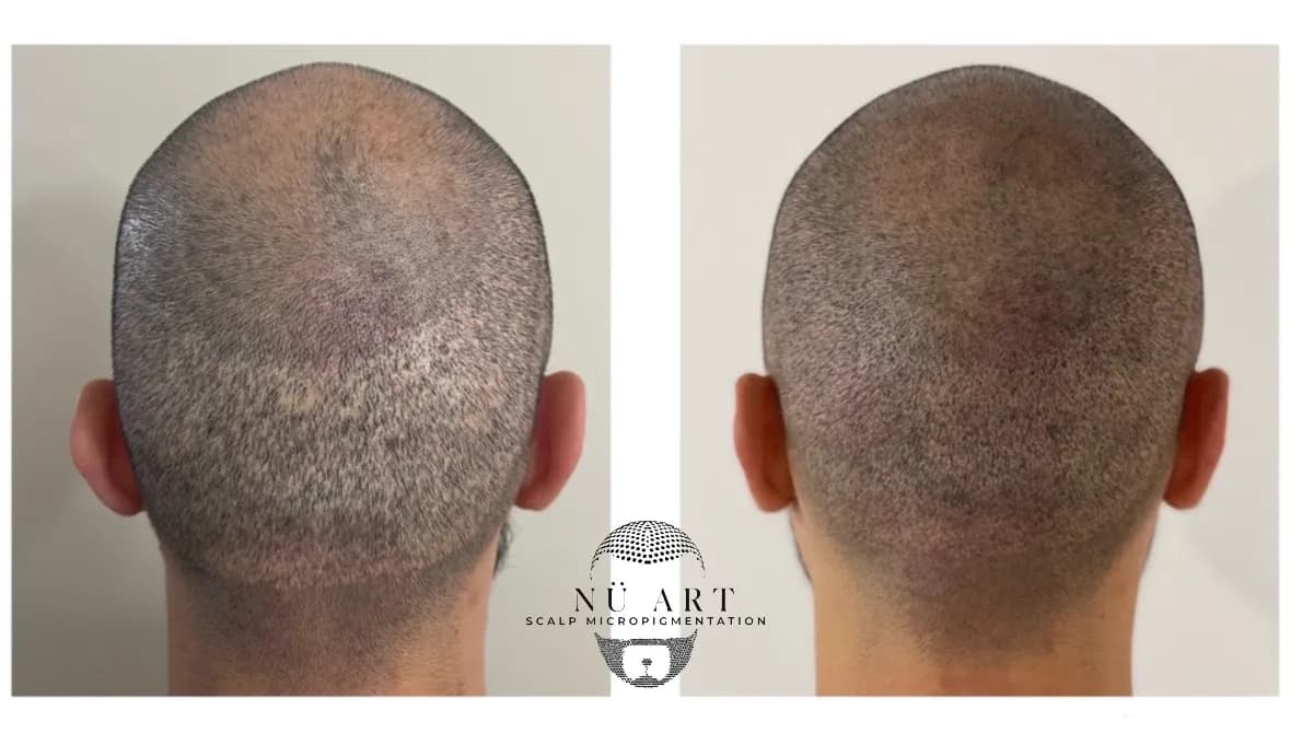 Nuart Scalp micropigmentation — scalp micropigmentation studio in Vancouver