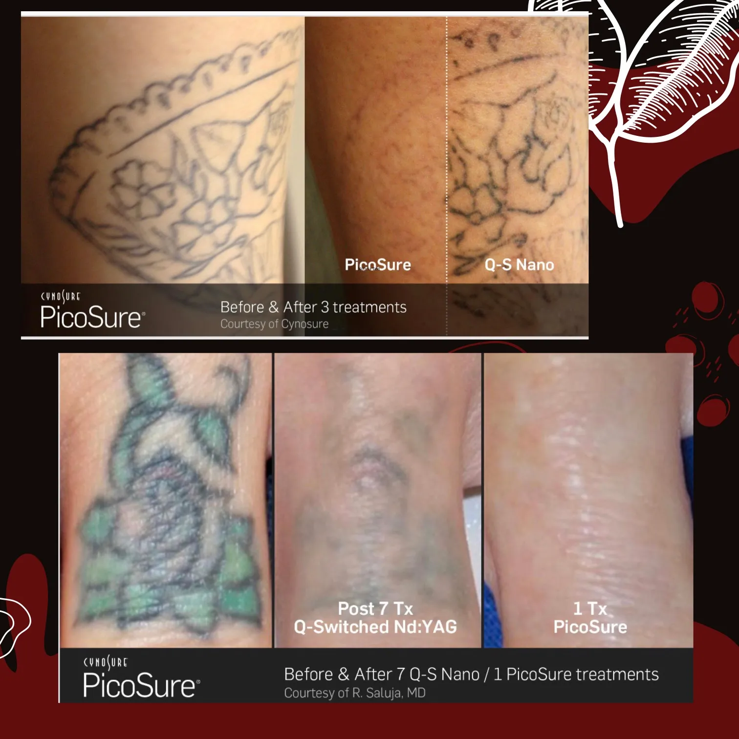 Renued YEG — scalp micropigmentation studio in Edmonton