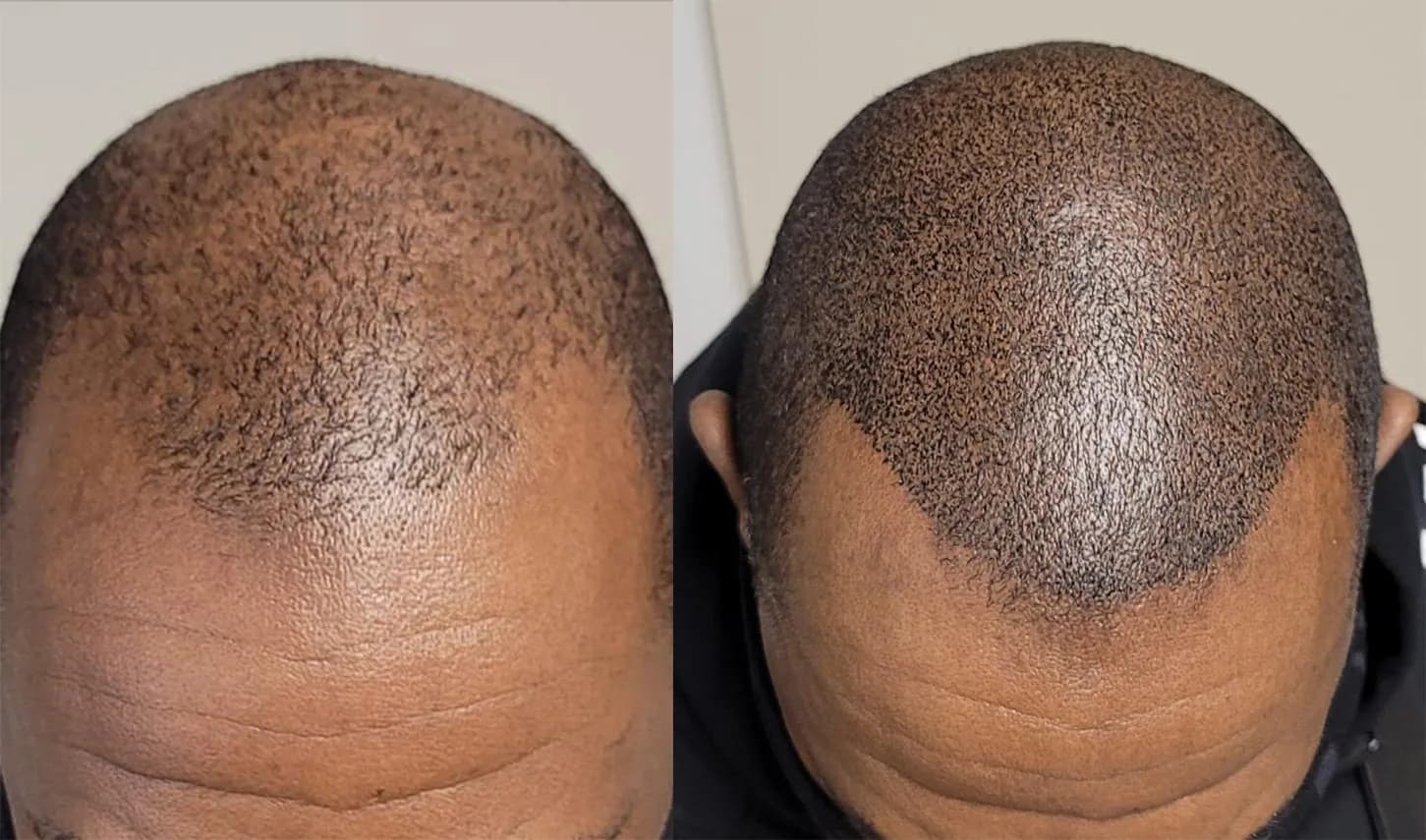 Scalp & Hair Loss Treatment Centre — scalp micropigmentation studio in Brampton