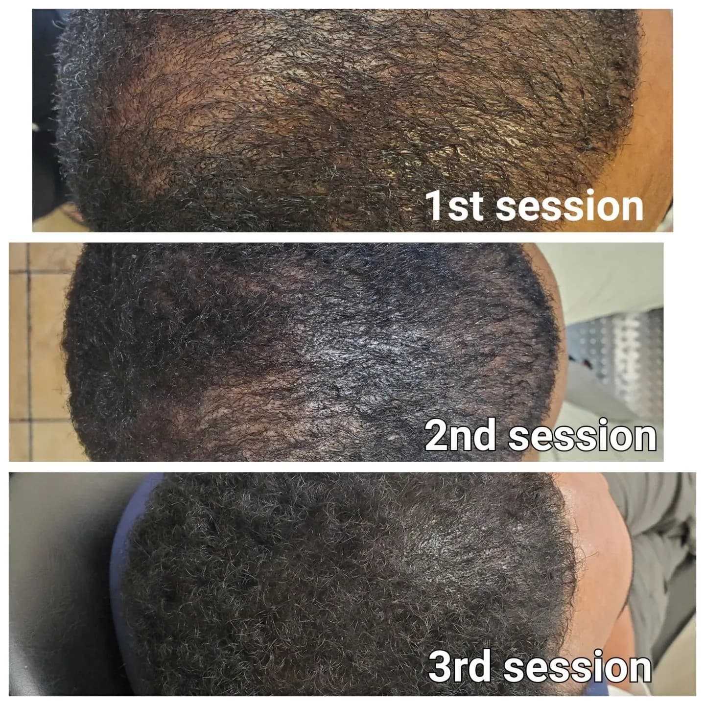 Scalp Renew SMP — scalp micropigmentation studio in Toronto