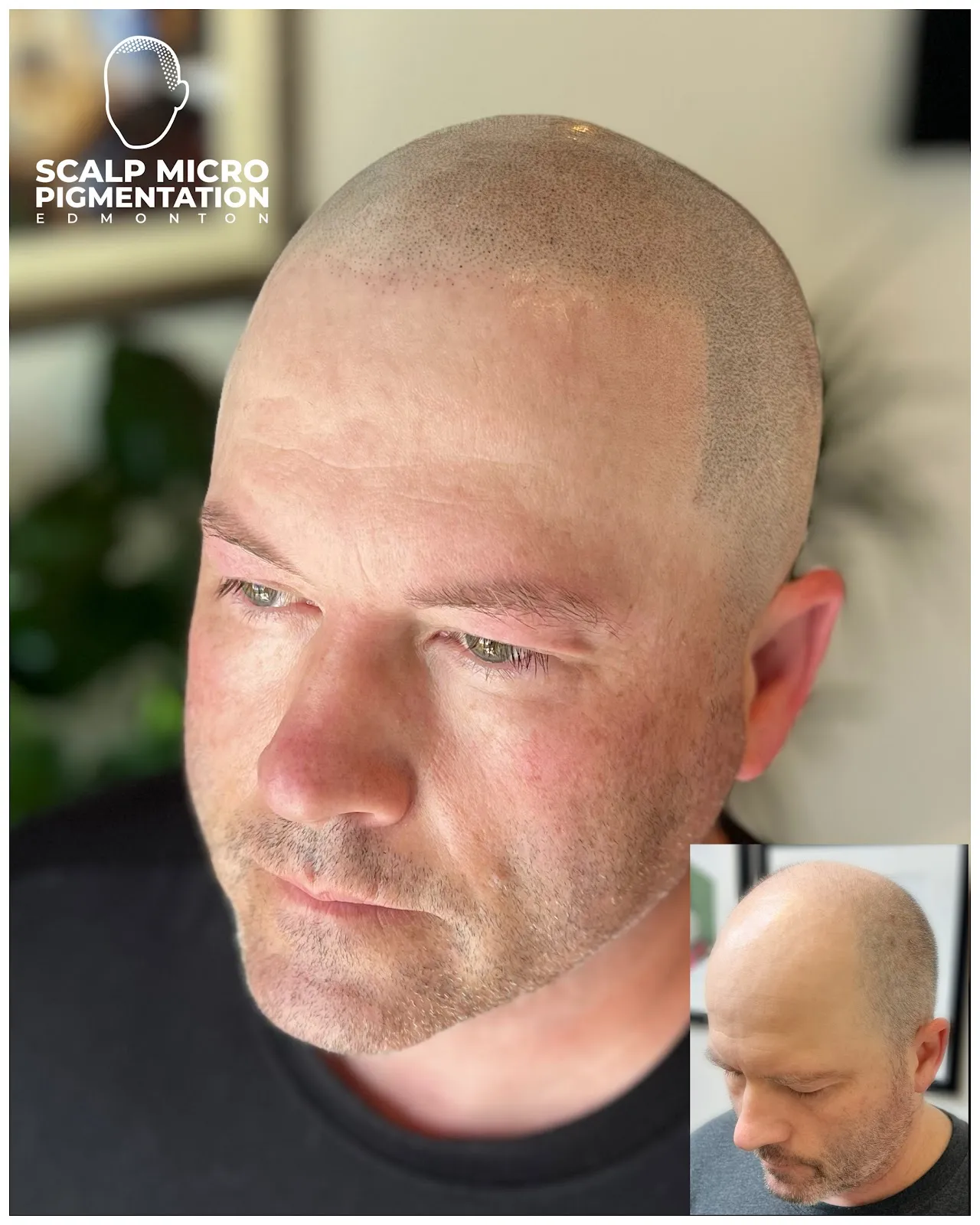 SCALPMICRO Scalp Micropigmentation Edmonton — scalp micropigmentation studio in Edmonton