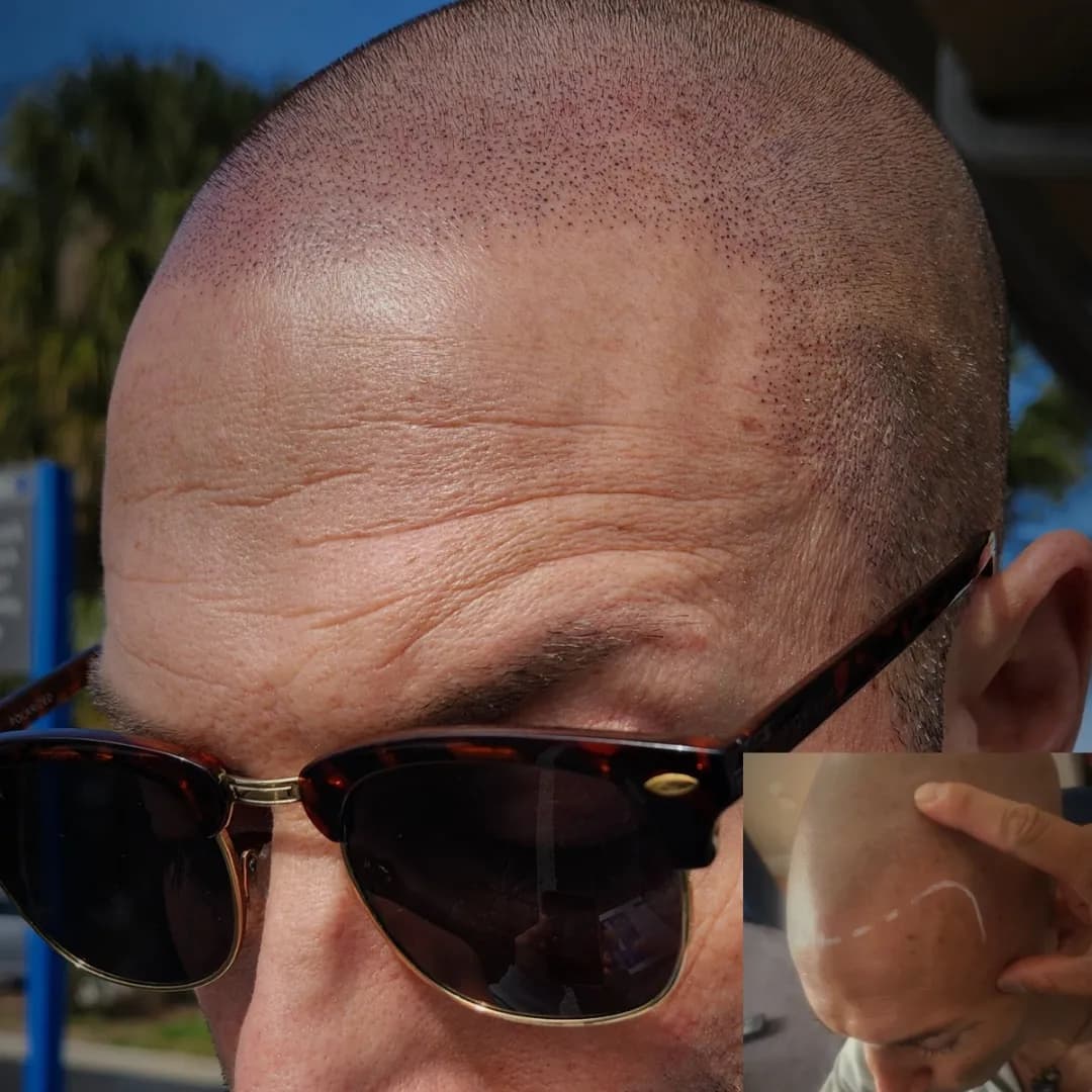 SEAN INKS — scalp micropigmentation studio in Laval
