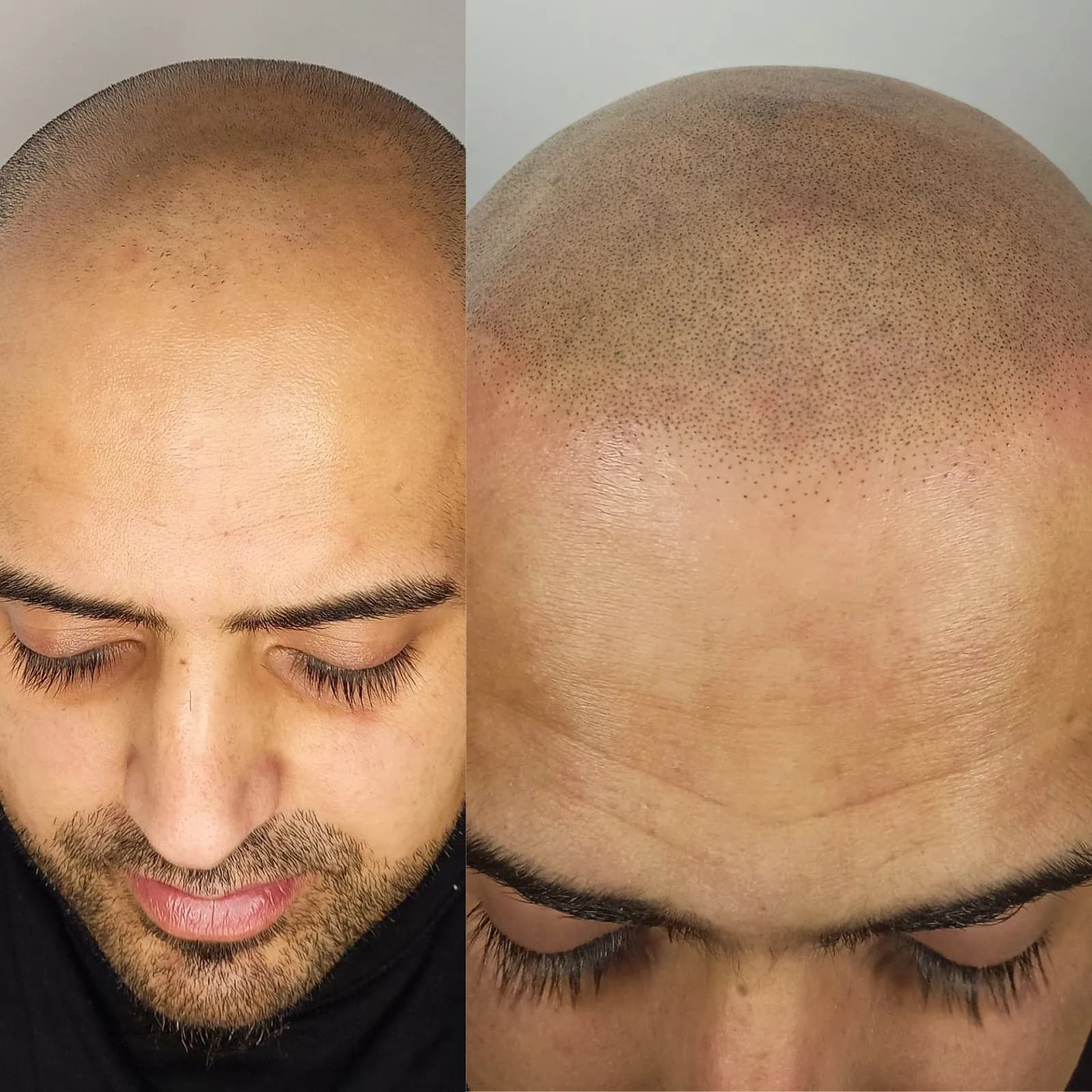 Skinspire SMP — scalp micropigmentation studio in Halifax