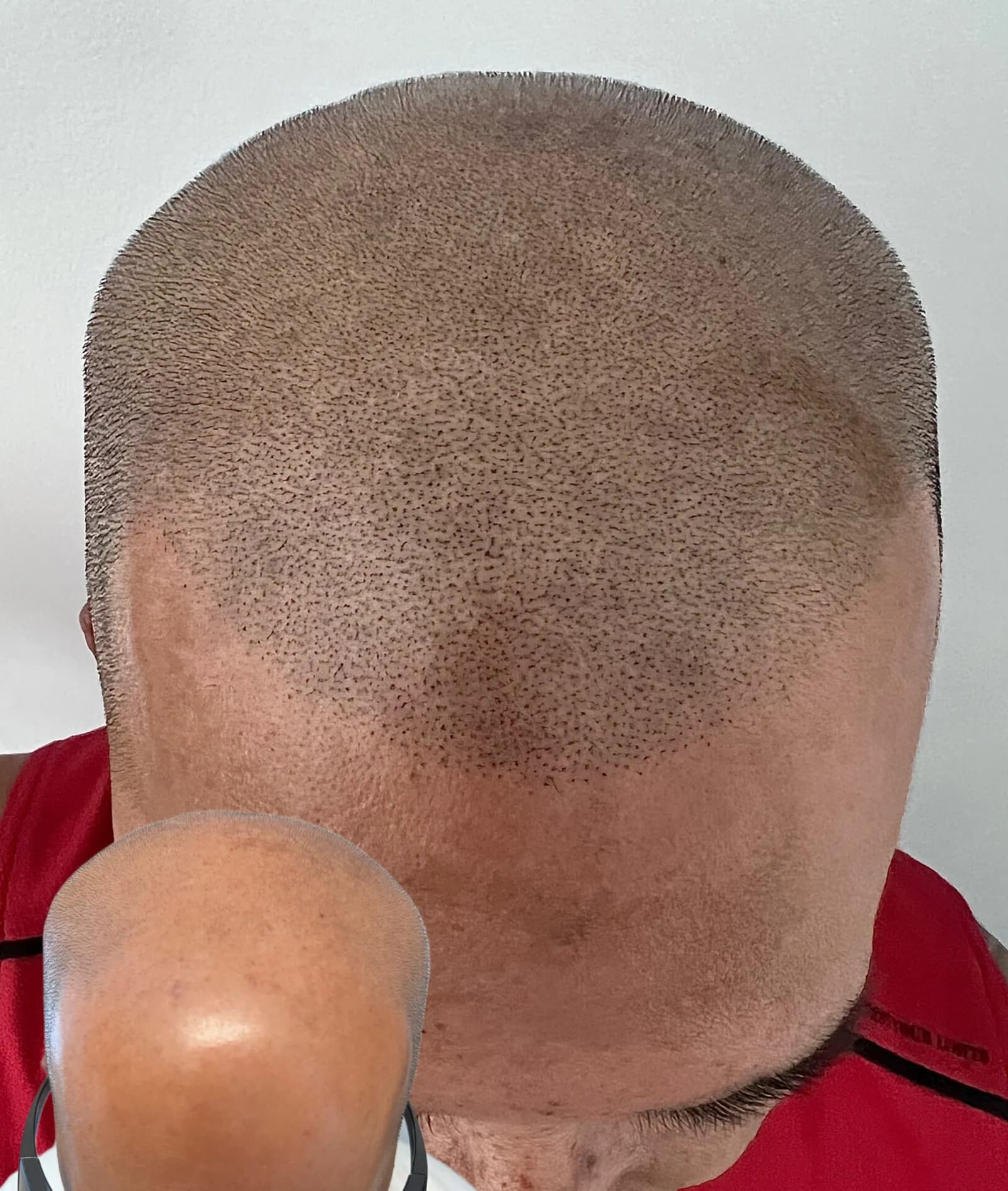 SMP by Rachel — scalp micropigmentation studio in Vancouver