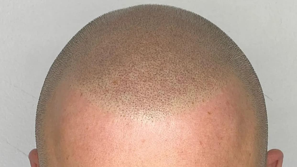 SMP DON — scalp micropigmentation studio in Toronto