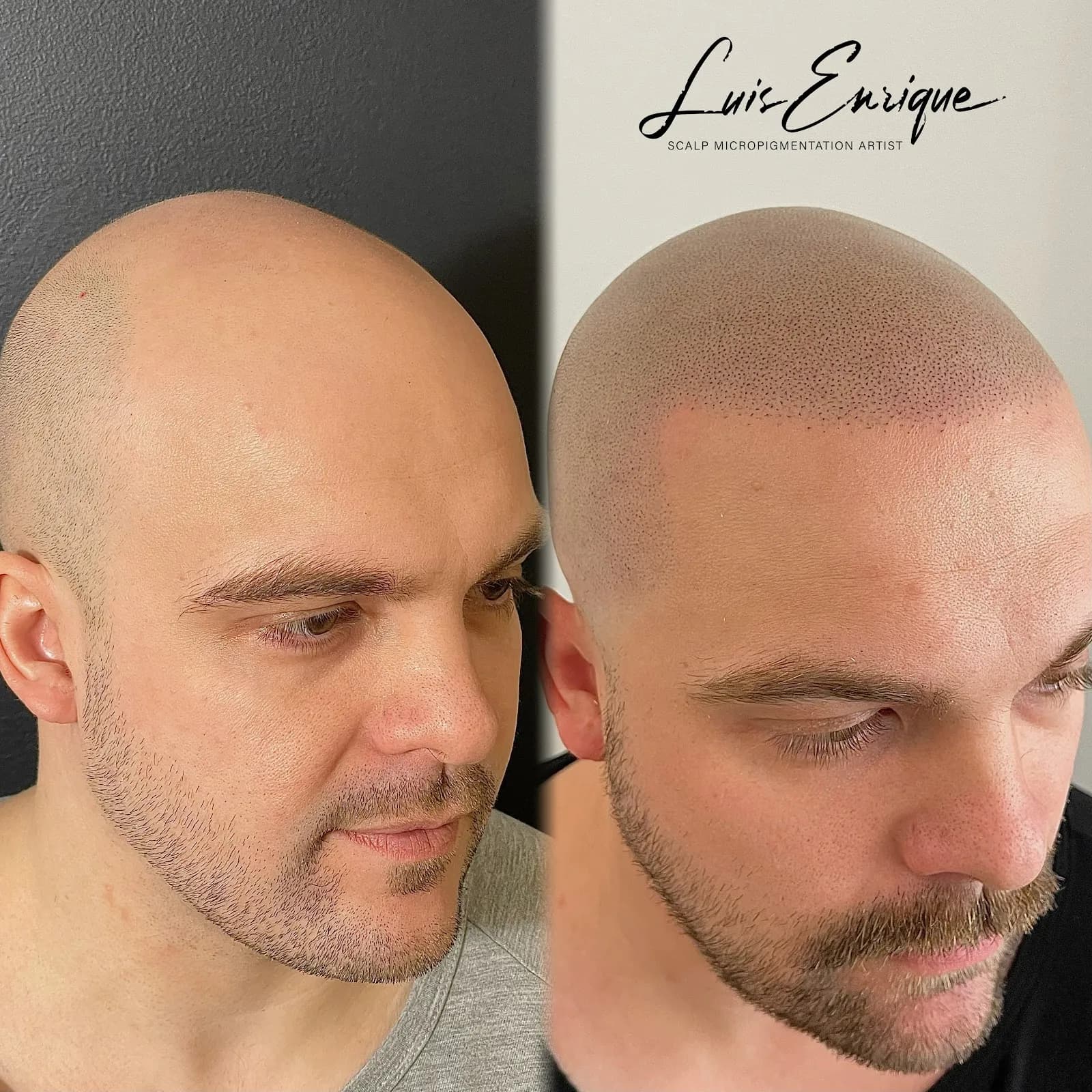 SMP Vancouver - Hair Tattoo Inc. | SMP By Luis Enrique — scalp micropigmentation studio in Vancouver