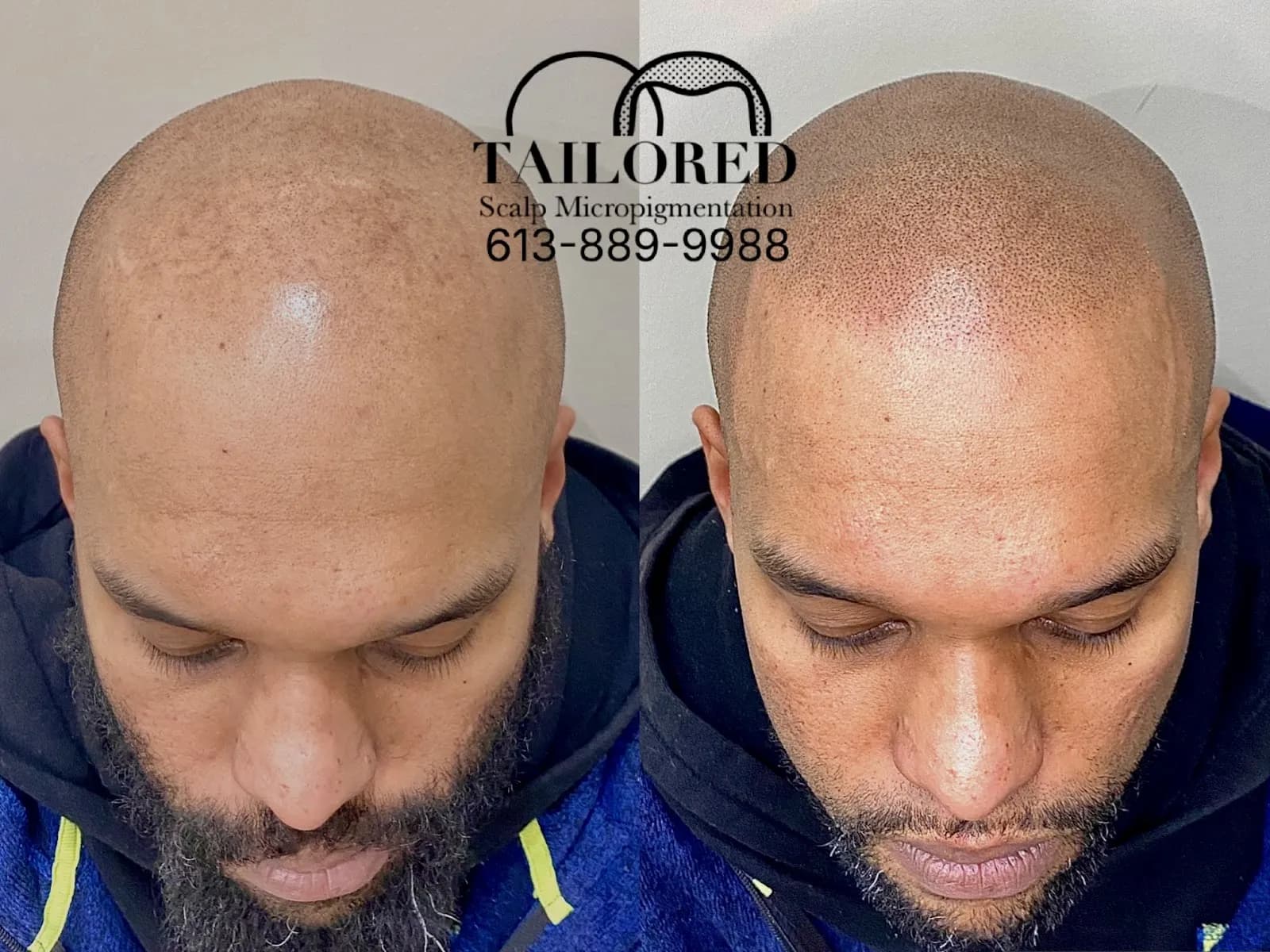Tailored Scalp Micropigmentation — scalp micropigmentation studio in Ottawa