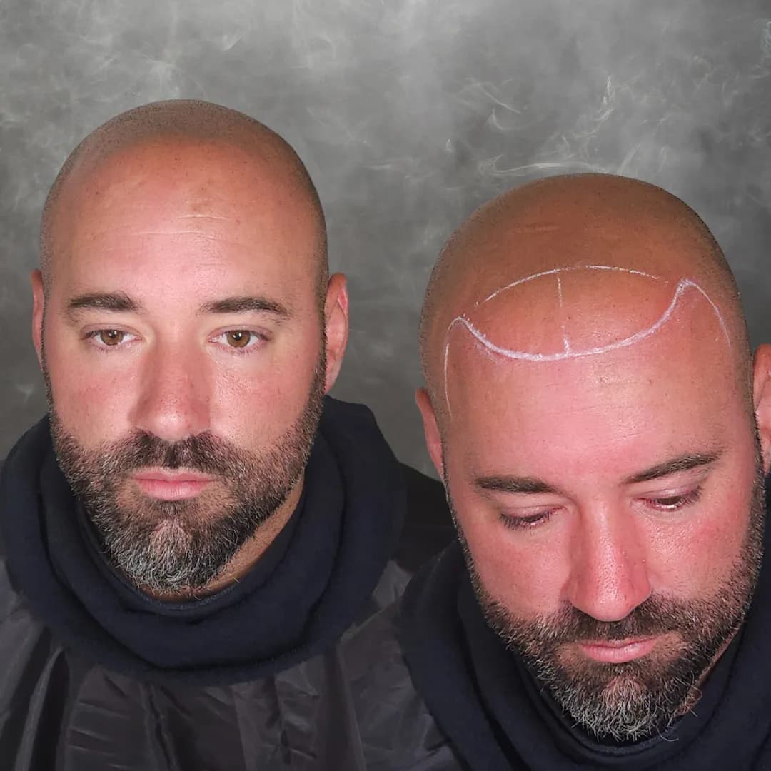 The Bare house - Scalp Micropigmentation — scalp micropigmentation studio in Ottawa