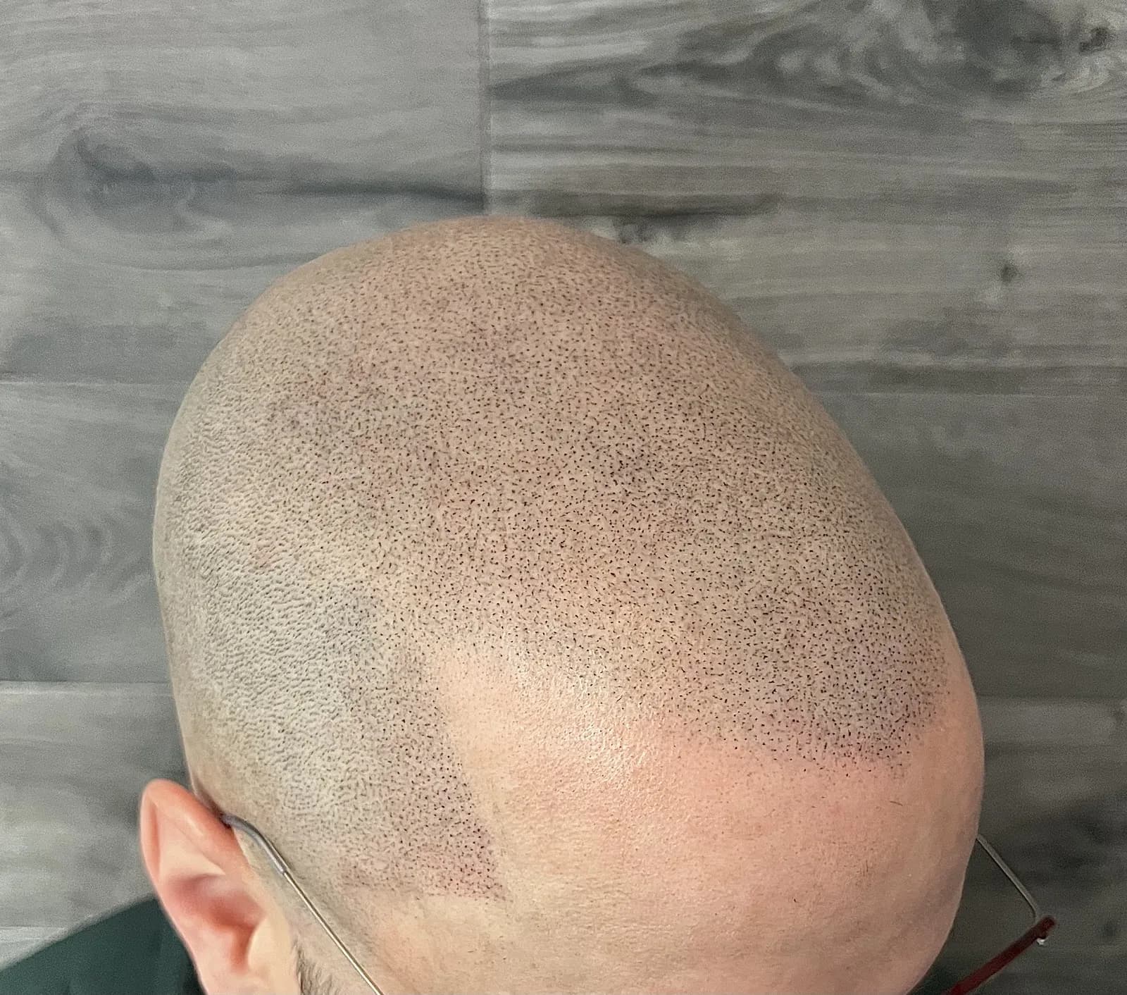 Vancouver INK Scalp Micropigmentation — scalp micropigmentation studio in Vancouver