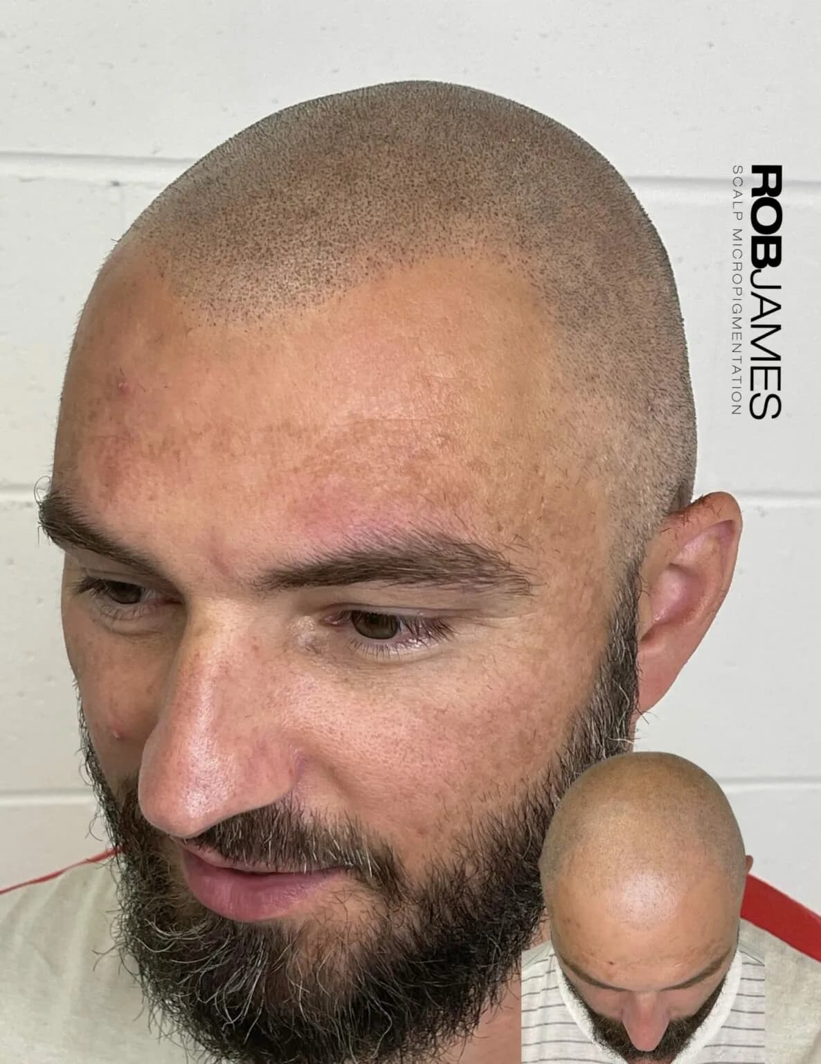 Vancouver SMP | Advanced Scalp Micropigmentation Artist - Rob James — scalp micropigmentation studio in Vancouver