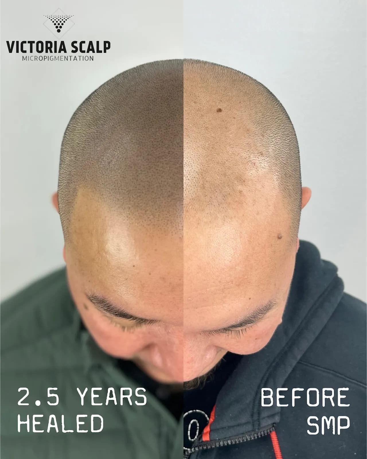 Victoria Scalp Micropigmentation — scalp micropigmentation studio in Victoria