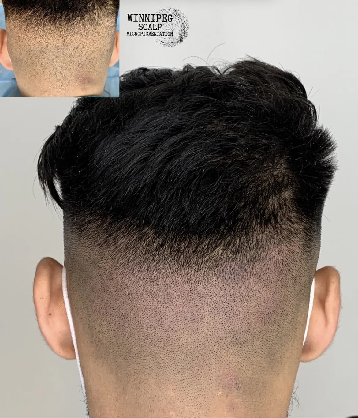 Winnipeg Scalp Micropigmentation — scalp micropigmentation studio in Winnipeg